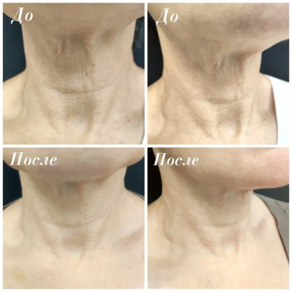 Стерильный концентрат, биорепарант Estefarm, COLLAPRO collagen 45+, 5ml