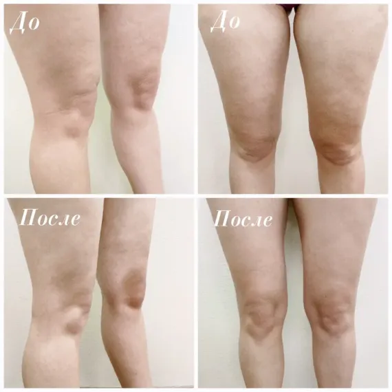 EsteLIPO  Body: Инновационный стерильный концентрат направленного действия для эффективной липокоррекции любых зон тела.