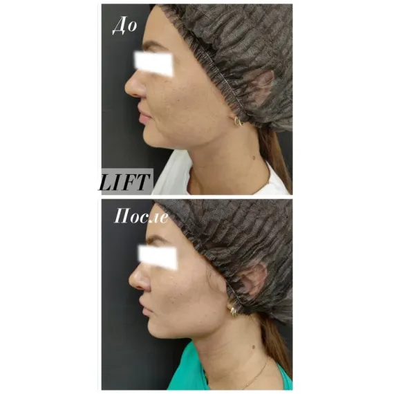 Cтерильный концентрат для экспресс-лифтинга ESTEFARM, Este LIFT, 5ml