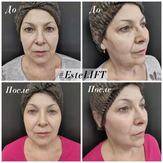 Cтерильный концентрат для экспресс-лифтинга ESTEFARM, Este LIFT, 5ml