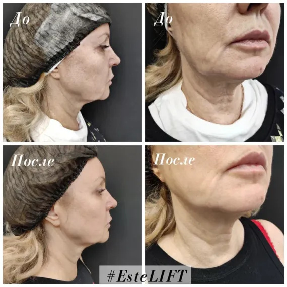 Cтерильный концентрат для экспресс-лифтинга ESTEFARM, Este LIFT, 5ml