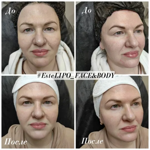 EsteLIPO Face & Body: Непрямой липолитик с мощным лимфодренажем и коллагеностимуляцией. Концентрированный, безболезненный при разведении, не требует анестезии. Уменьшает объемы и подтягивает кожу.