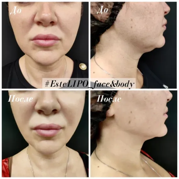 EsteLIPO Face & Body: Непрямой липолитик с мощным лимфодренажем и коллагеностимуляцией. Концентрированный, безболезненный при разведении, не требует анестезии. Уменьшает объемы и подтягивает кожу.