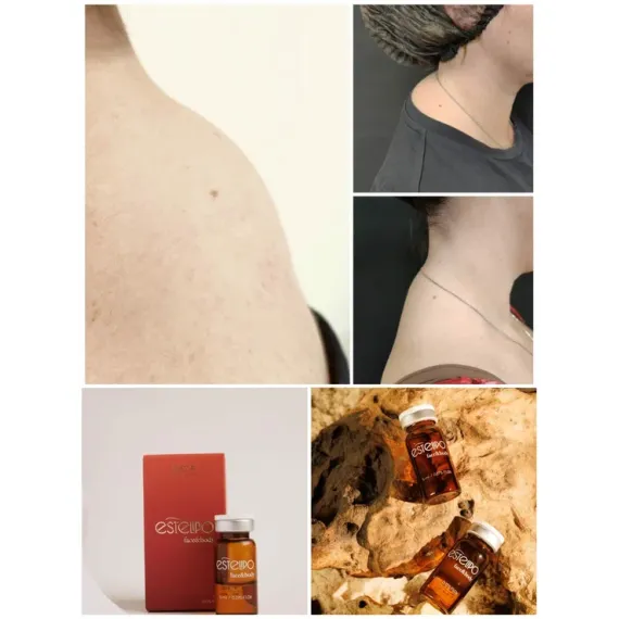 EsteLIPO Face & Body: Непрямой липолитик с мощным лимфодренажем и коллагеностимуляцией. Концентрированный, безболезненный при разведении, не требует анестезии. Уменьшает объемы и подтягивает кожу.