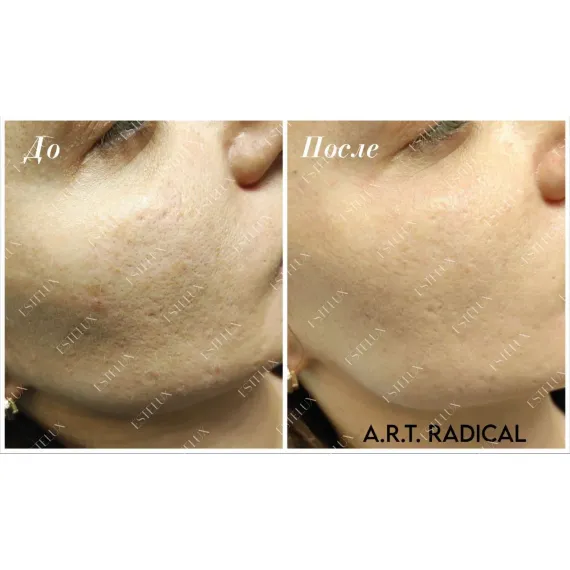 Экзосомный бустер ESTEFARM, EsteLUX A.R.T. RADICAL , 3 ml.