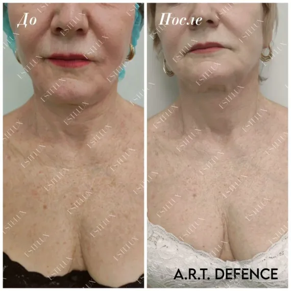 Экзосомный бустер ESTEFARM, EsteLUX A.R.T. DEFENCE, 3 ml.