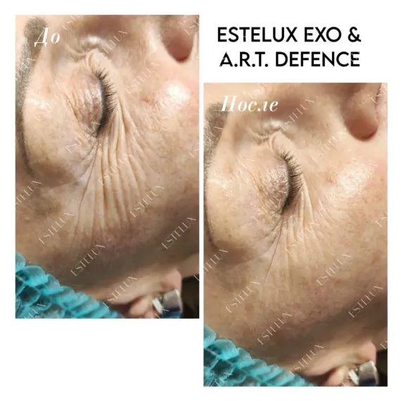 Двухкомпонентный комплекс A.R.T. терапии из экзосом ESTEFARM, EXO A.R.T. 30 mg + бустер DEFENCE 3 ml.