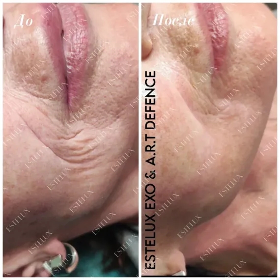 Двухкомпонентный комплекс A.R.T. терапии из экзосом ESTEFARM, EXO A.R.T. 30 mg + бустер DEFENCE 3 ml.