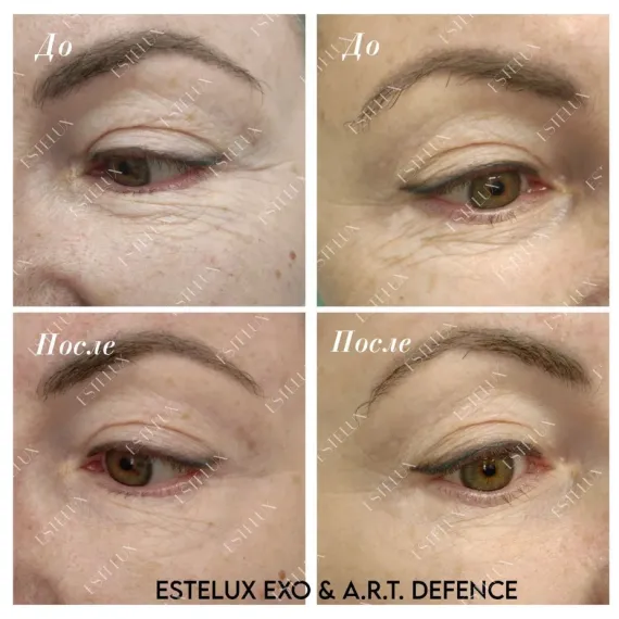 Двухкомпонентный комплекс A.R.T. терапии из экзосом ESTEFARM, EXO A.R.T. 30 mg + бустер DEFENCE 3 ml.