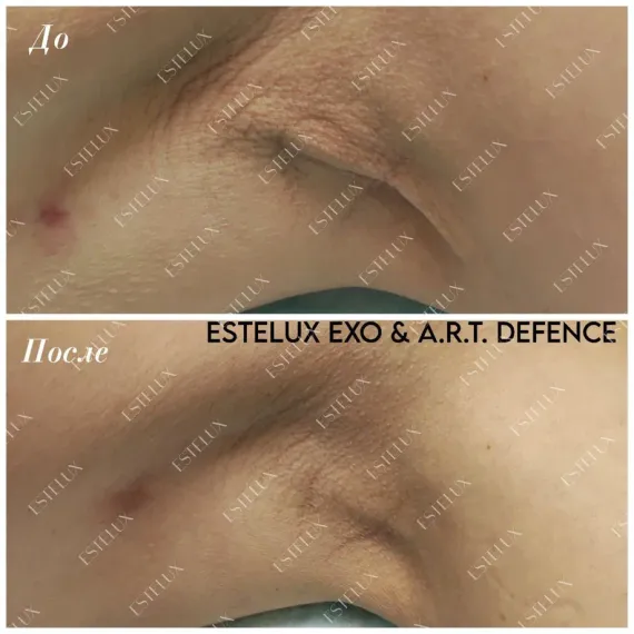 Двухкомпонентный комплекс A.R.T. терапии из экзосом ESTEFARM, EXO A.R.T. 30 mg + бустер DEFENCE 3 ml.