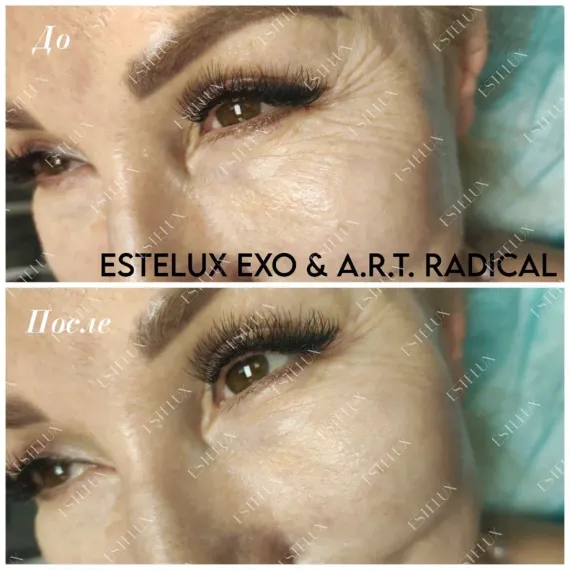 Двухкомпонентный комплекс A.R.T. терапии из экзосом ESTEFARM, EXO A.R.T. 30 mg + бустер RADICAL 3 ml.