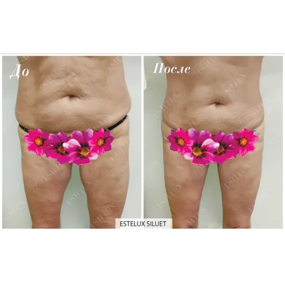 ESTELUX SILUET: Многофункциональный препарат нового поколения для комплексной липокоррекции и моделирования силуэта