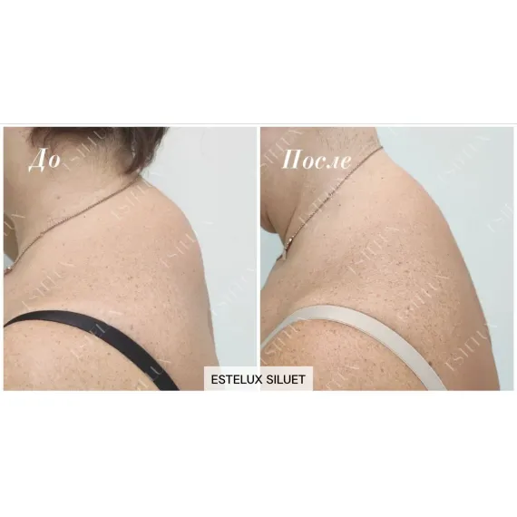 ESTELUX SILUET: Многофункциональный препарат нового поколения для комплексной липокоррекции и моделирования силуэта