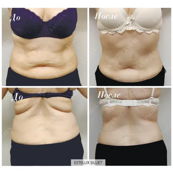 ESTELUX SILUET: Многофункциональный препарат нового поколения для комплексной липокоррекции и моделирования силуэта
