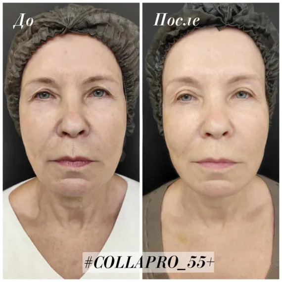 Стерильный концентрат, биорепарант Estefarm, COLLAPRO collagen 55+, 5ml