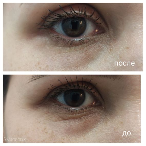 Cтерильный концентрат двойного действия ESTEFARM, миорелаксант и лимфодренаж Este EYE, 3ml