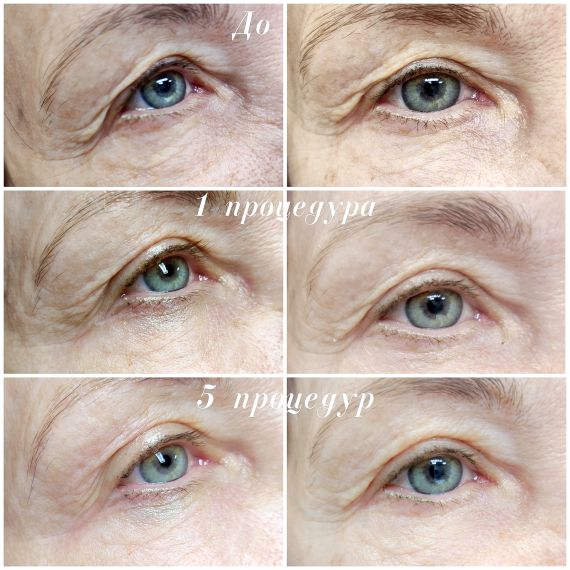 Cтерильный концентрат двойного действия ESTEFARM, миорелаксант и лимфодренаж Este EYE, 3ml