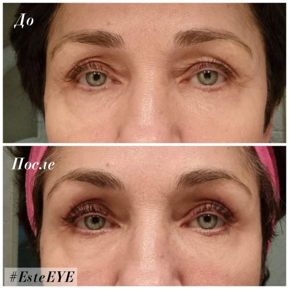 Cтерильный концентрат двойного действия ESTEFARM, миорелаксант и лимфодренаж Este EYE, 3ml