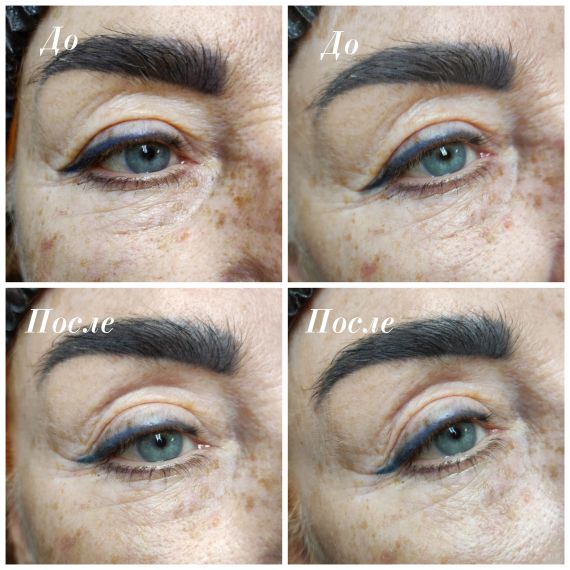 Cтерильный концентрат двойного действия ESTEFARM, миорелаксант и лимфодренаж Este EYE, 3ml