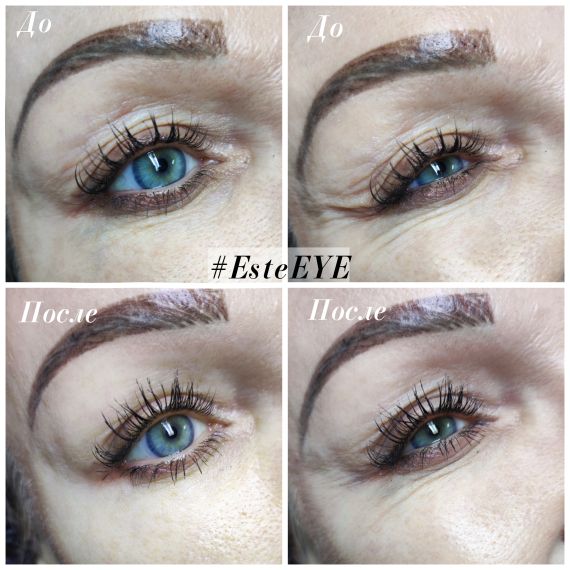 Cтерильный концентрат двойного действия ESTEFARM, миорелаксант и лимфодренаж Este EYE, 3ml